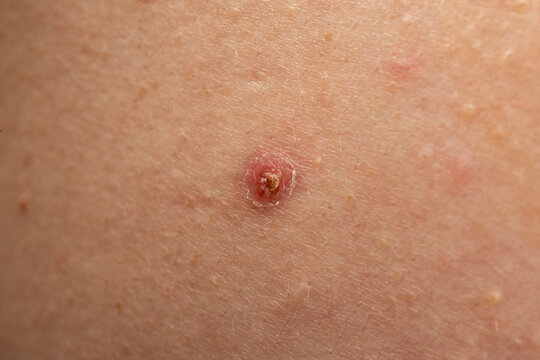 Acne on skin with comedone and sebum. Closeup of acne with papules and texture. Dermatology skincare for acne and epidermis. Macro detail of acne with irritation.