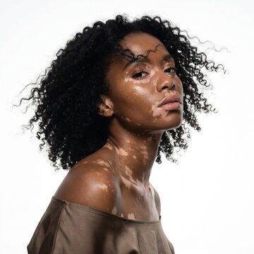 Portrait of girl with vitiligo posed against white background. Young African American model with expressive facial features, bouncy curls.  Body positivity concept.  World Vitiligo Day.