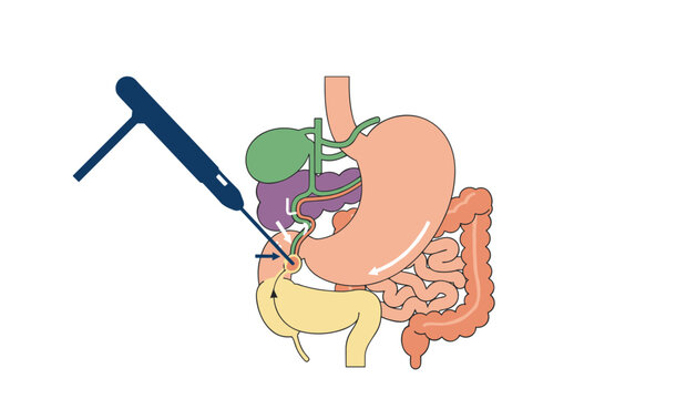 Diagram of endoscopic retrograde cholangiopancreatography procedure showing the insertion of a catheter into the bile duct.