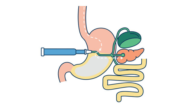 Medical diagram showing an injection procedure in the stomach and digestive organs including pancreas and gallbladder.