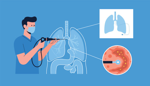 Detailed medical illustration showing a male doctor performing a bronchoscopy procedure to inspect the inside of a patient lungs.