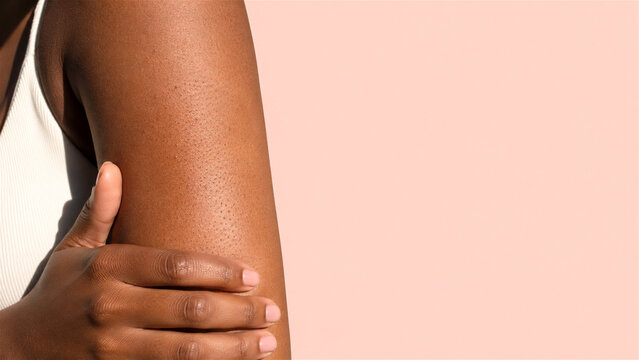 woman touching arm showing skin texture and keratosis pilaris condition. Skincare and dermatological health concept for cream advertising or medical treatment review. Natural beauty