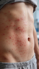 Naklejka premium Man with itchy red rash on abdomen. Dermatological skin condition showing signs of irritation and allergy. Healthcare diagnosis of dermatitis, eczema and skin inflammation symptoms.