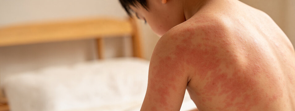 Child with severe red skin rash on back and shoulder. Dermatological disease or allergic reaction symptoms. Medical examination for pediatrician or clinic healthcare diagnosis banner with copyspace..