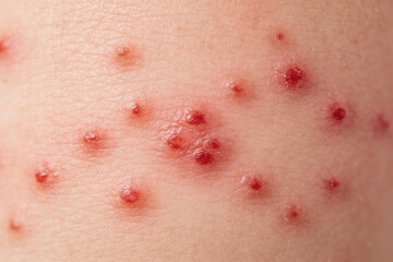 Fototapeta premium Skin rash with red pimples on human body. Close up of measles symptom on kid skin. Viral infection and outbreak awareness. Dermatology concept for medical study and patient treatment.