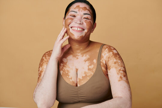 woman with unique skin - Vitiligo