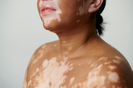 Anonymous  woman - Vitiligo