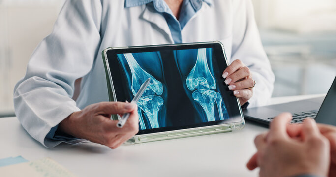 Tablet screen, consulting and doctor hands with xray for knee injury, diagnostic results or help. Patient, woman or tech with CT scan review for joint damage, bone marrow transplant or clinic checkup