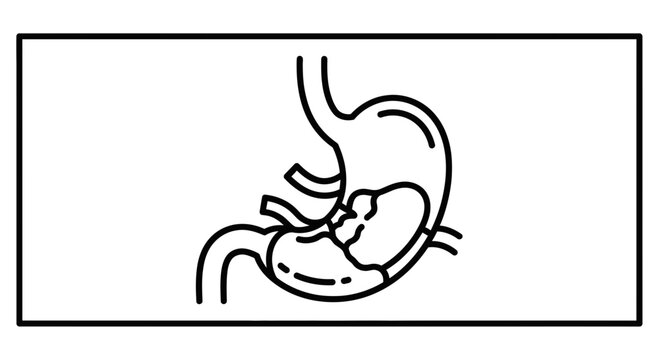 Medical Illustration of Stomach Hernia: Hiatal Hernia Diagram