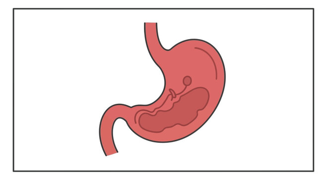 Gastric Bezoar: Stomach Stone Formation Illustration