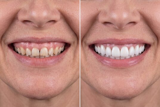 Before and after comparison of a woman's smile showcasing dental transformation with bright white veneers.