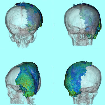 3D CT shows extensive left mastoid abscess extending to temporal lobe, cerebellum, scalp, and deep neck spaces. Derived from real CT imaging data, not AI-generated