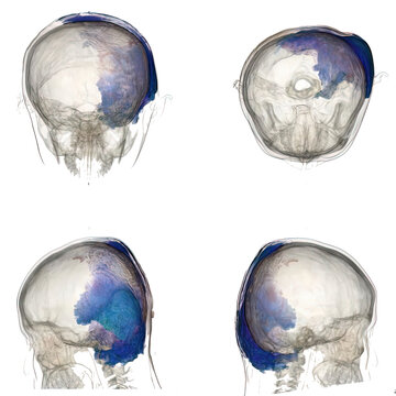 3D CT shows extensive left mastoid abscess extending to temporal lobe, cerebellum, scalp, and deep neck spaces. Derived from real CT imaging data, not AI-generated