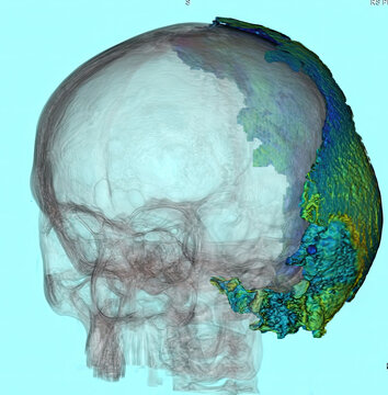 3D CT shows extensive left mastoid abscess extending to temporal lobe, cerebellum, scalp, and deep neck spaces. Derived from real CT imaging data, not AI-generated