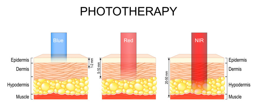 Phototherapy. Light penetration and skin effects comparison for NIR near infrared wavelength,