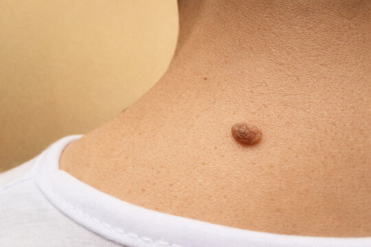Close-Up Macro Of Benign Skin Mole For Medical Dermatology Examination