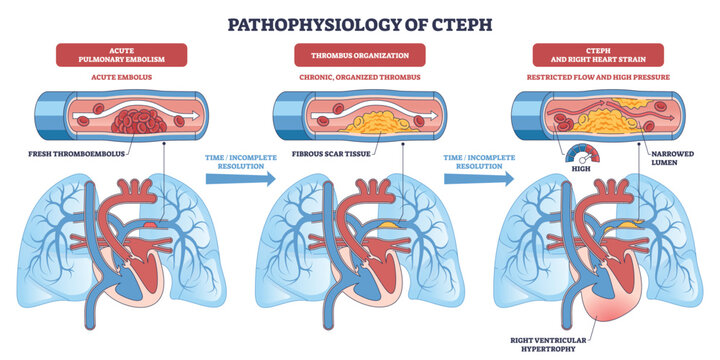 Pathophysiology of CTEPH depicts embolus becoming organized thrombus, narrowing pulmonary arteries and causing right ventricular strain, vessels, lungs, heart. Outline diagram