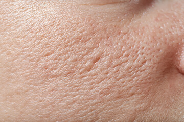 Fototapeta premium Macro close up of facial skin with visible pores acne marks and uneven tone showing natural texture and soft lighting
