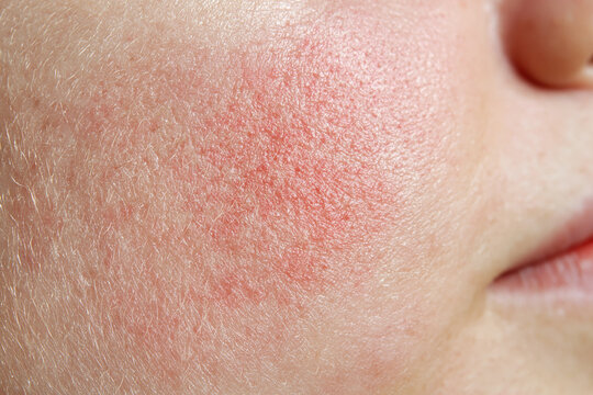 Red irritated cheek with visible pores and fine hair, sensitive skin reaction with flushed texture and slight inflammation on facial skin