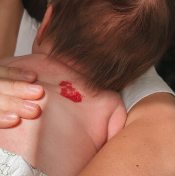 Nevus of the unna in the form of a heart on the back of a newborn baby. A birthmark is a heart on the baby's skin. Angel's Kiss. Medicine and Children's Health