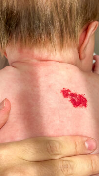 Nevus of the unna in the form of a heart on the back of a newborn baby. A birthmark is a heart on the baby's skin. Angel's Kiss. Medicine and Children's Health