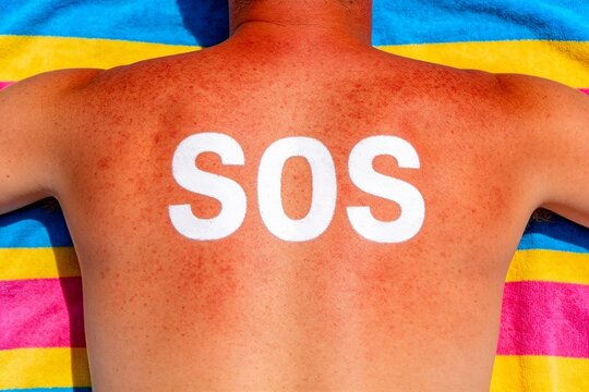 Person with SOS on sunburned back
