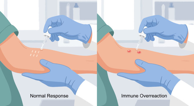 Allergy Test: Normal vs. Immune Reaction on Arm, Medical Illustration