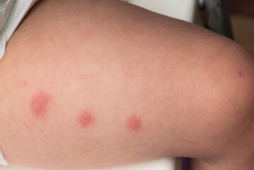 Fototapeta premium Mosquito bites on toddler leg with red skin reaction close up