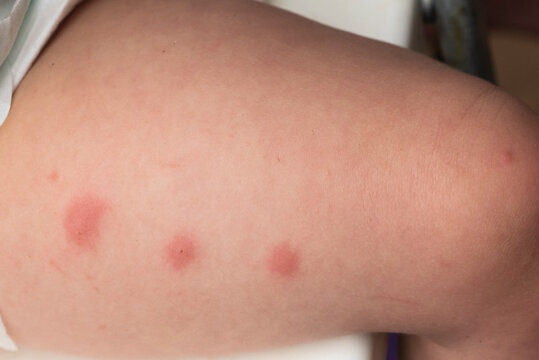 Mosquito bites on toddler leg with red skin reaction close up