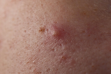 Fototapeta premium Acne skin pimple. Skin problem with acne bumps. Irritated Acne texture. Close up Acne issue.