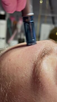 Client receives a microneedling treatment in a skincare clinic. The technician uses a device on the client's forehead. The setting is bright and clean, with various tools visible.