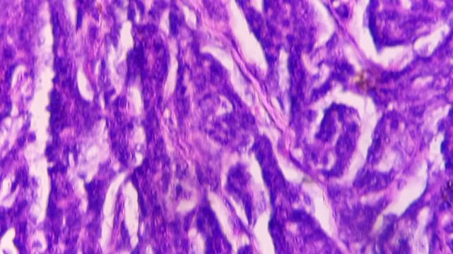Histopathology of right breast lump. Infiltrating ductal carcinoma (nst), well differentiated G-1. Section of breast tumour reveal features of an infiltrating ductal carcinoma. 