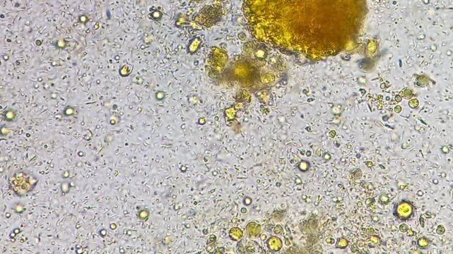 Microscopic footage of human feces or stool showing epithelial cells, pus cells, fat globules, Vegetable cells and bacteria.