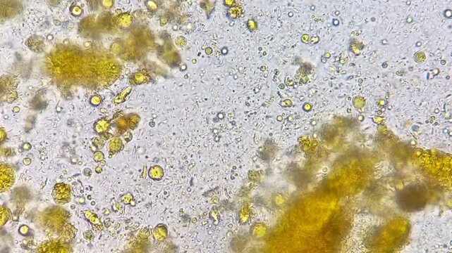 Microscopic footage of human feces or stool showing epithelial cells, pus cells, fat globules, Vegetable cells and bacteria.