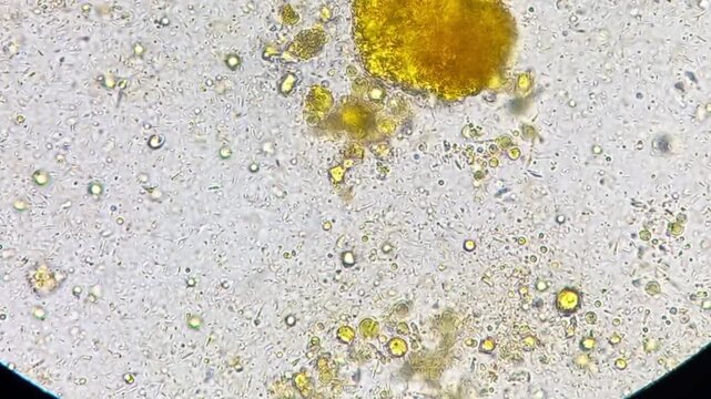 Microscopic footage of human feces or stool showing epithelial cells, pus cells, fat globules, Vegetable cells and bacteria.
