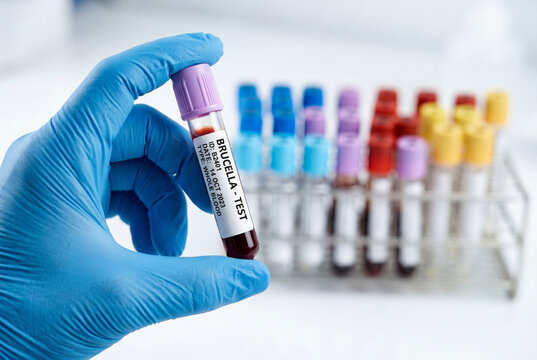 Medical professional holding brucella test blood sample tube