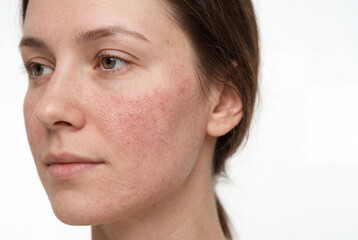 Naklejka premium A young woman stands facing sideways with visible redness on her face. She looks calm and focused while light from a nearby source highlights her features. The setting is bright and simple