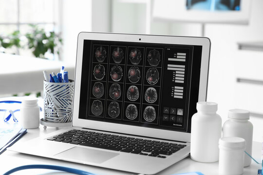 Medical laptop displaying brain MRI scans for neurological diagnosis and treatment planning in a clinical setting, the scene includes medical supplies like pill bottles and a stethoscope, indicating