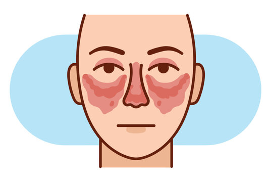 Medical illustration of a human face showing a red butterfly rash across the nose and cheeks typical of lupus.