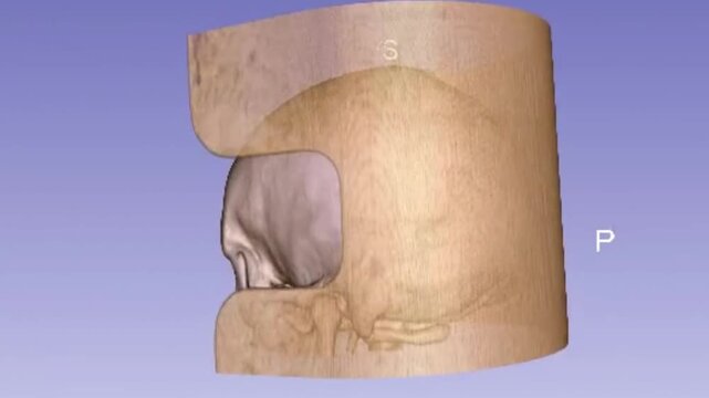 3D CT Scan Rotation of Human Skull and Brain Showing Intracranial Cranial Bone and Soft Tissue Anatomy