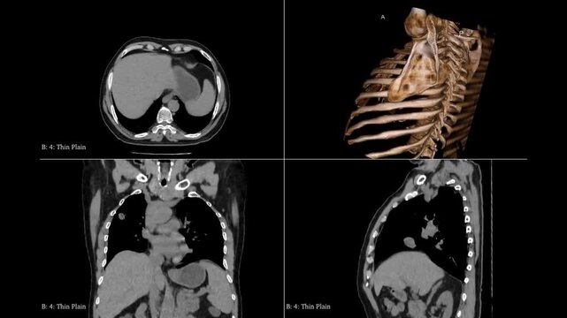 Forensic 3D HRCT Volumetric Reconstruction of Human Facial Skeleton and Nasal Cavity Complex