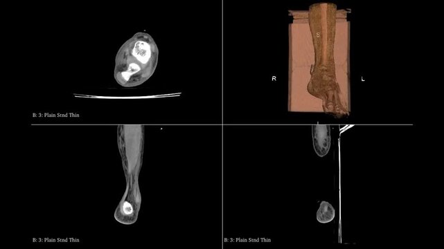 Biomechanical 3D Model Render of Left Ankle Joint Architecture for Surgical Preoperative Planning