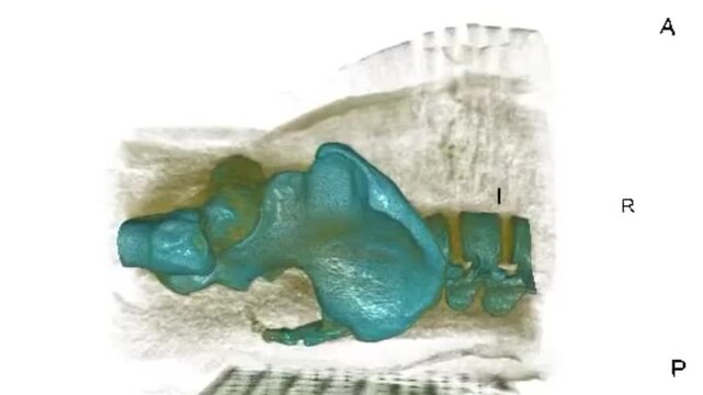 3D Computed Tomography Pelvic Scan Loop for Fracture Evaluation and Orthopedic Injury Tracking