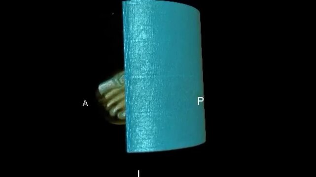 Biomechanical 3D Model Render of Right Ankle Joint Architecture for Surgical Preoperative Planning