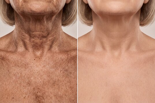 Comparison of aged and rejuvenated skin on the neck and d&eacute;colletage, showing wrinkles and sunspots versus smooth skin.
