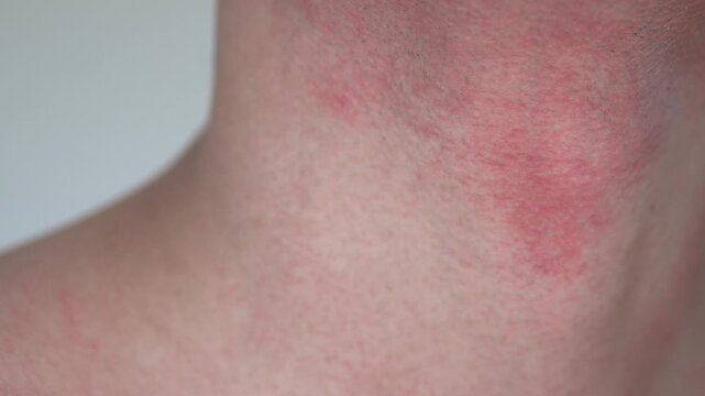 A man&rsquo;s neck showing skin redness, irritation and razor burn after shaving. Visible beard stubble and inflamed skin highlight common grooming-related skin sensitivity and post-shave irritation