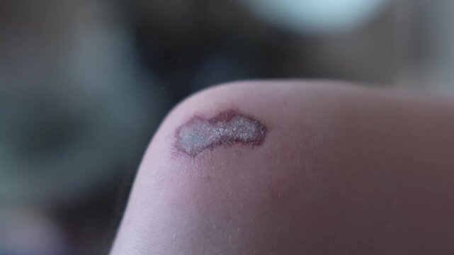 A teenager uses a prophylactic agent to treat an abrasion on their knee. Treating the wound with hydrogen peroxide. High quality FullHD footage