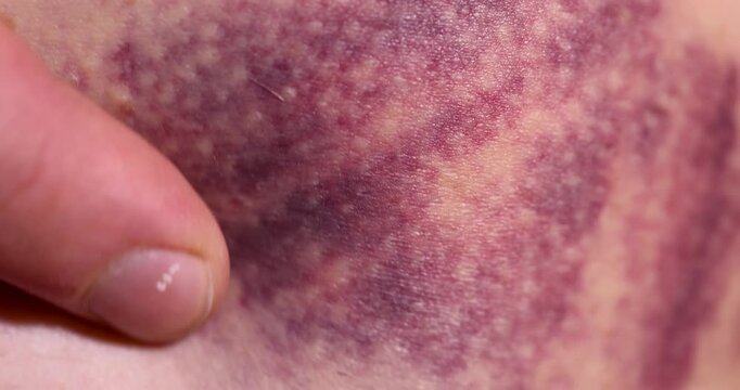 The hematoma is purple in color, subcutaneous hematoma is visible on the damaged area of the skin after a physical blow