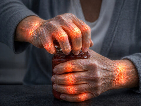 Arthritis Hand Pain, Rheumatoid Arthritis and Osteoarthritis Joint Inflammation Concept