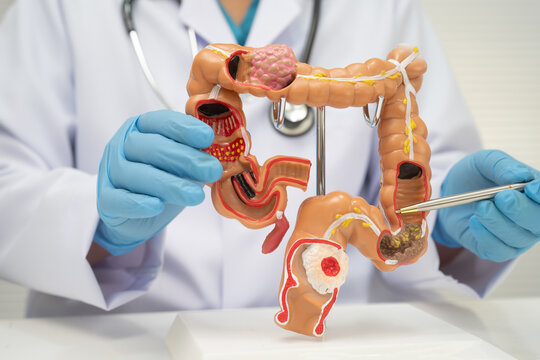 Colorectal cancer, doctor holding intestine colon human anatomy model.